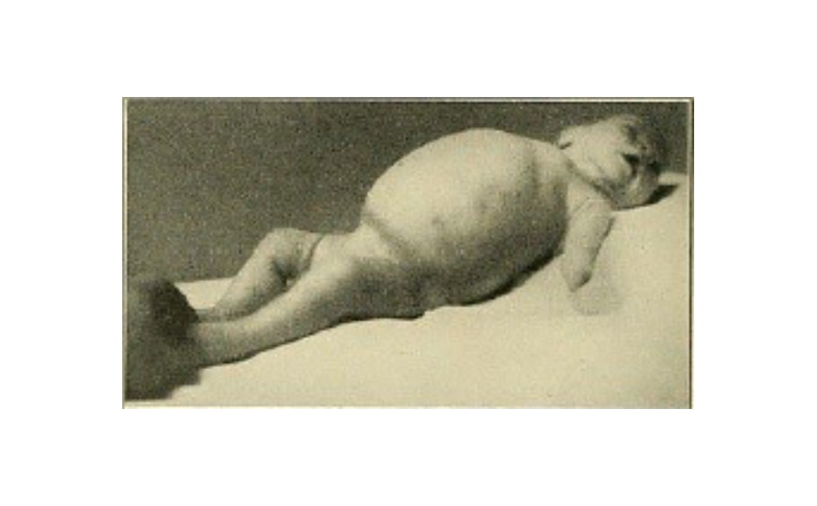 Chloecord cyst in children